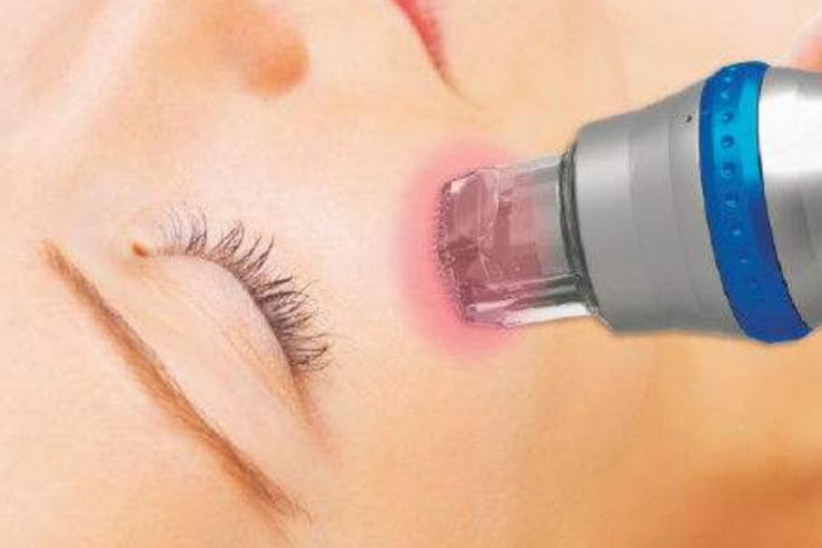 RF Needling Anti-Aging Stuttgart